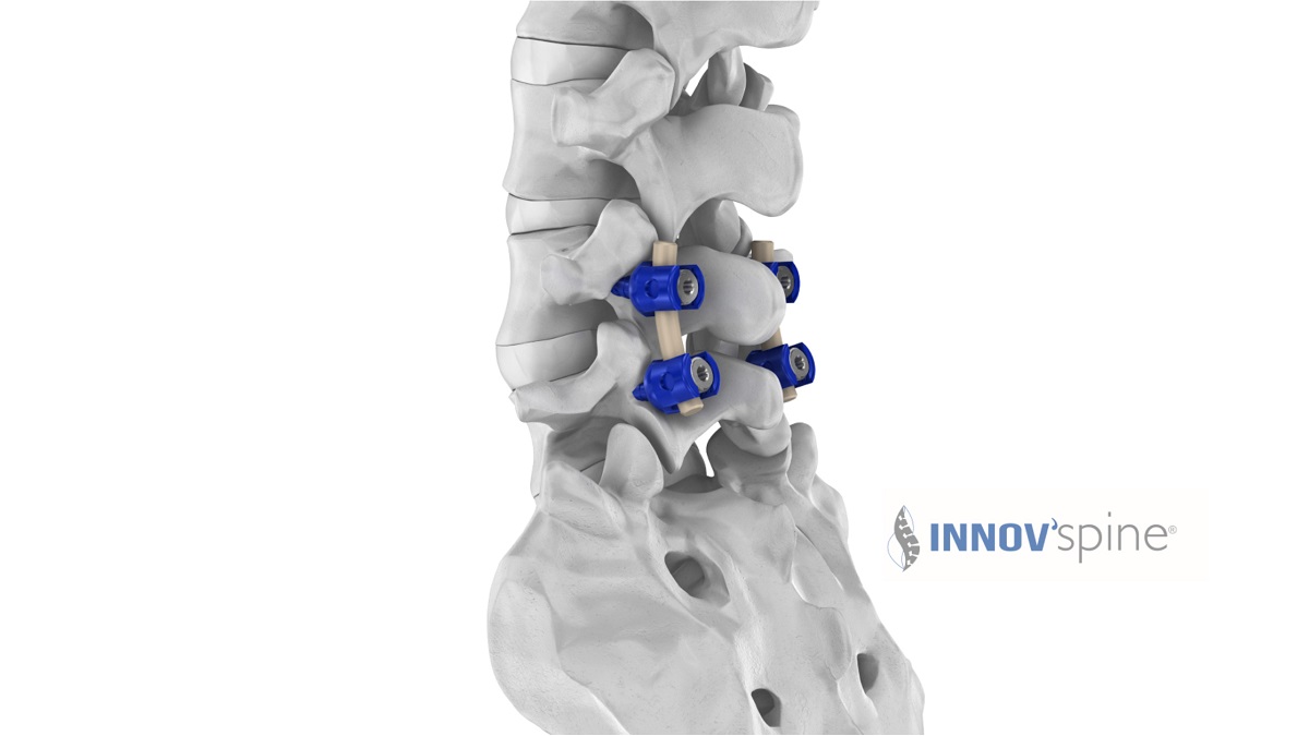 Semi-rigid spinal rods now available to bridge treatment gap