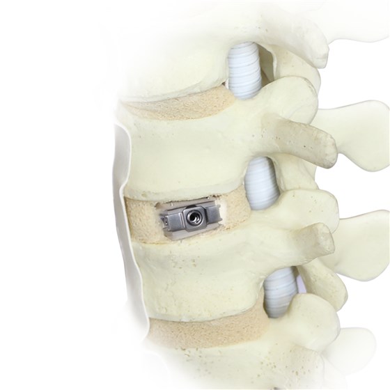 Uplifter™ Expandable Anterior Lumbar Interbody Fusion Device was demonstrated in a hands-on live workshop in Shanghai. © Fule